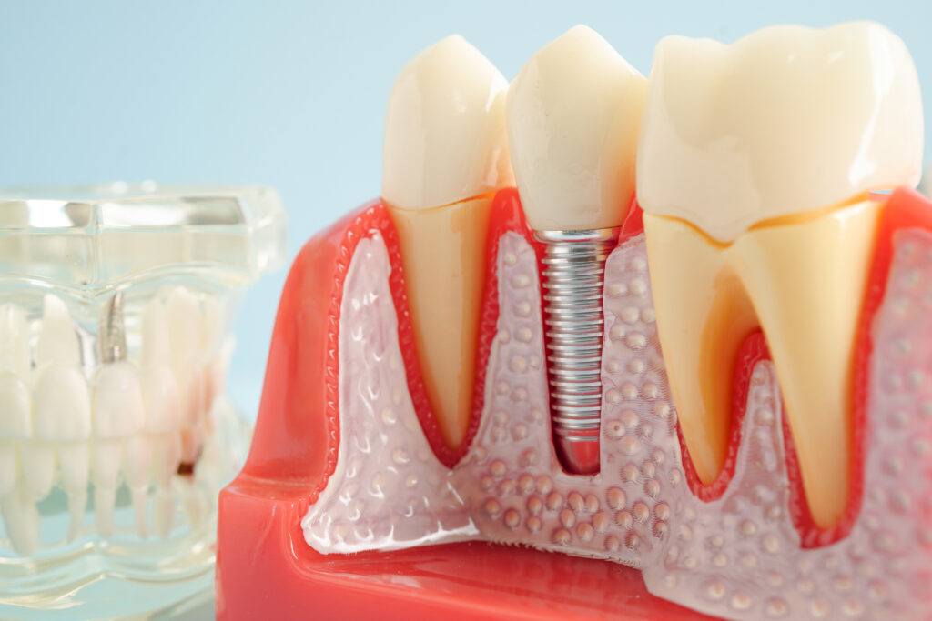 brooklyn perio dental implants