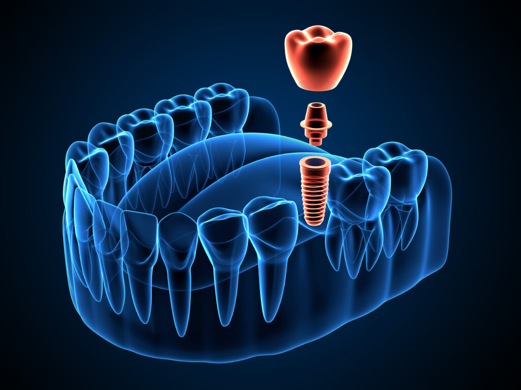 brooklyn dental implant technology