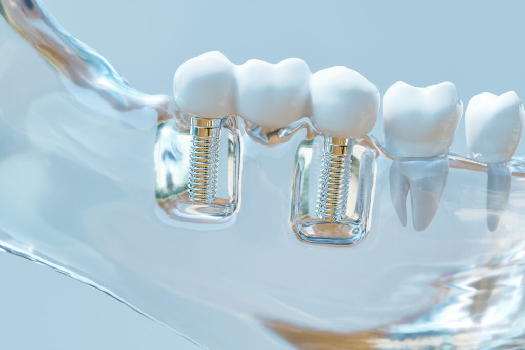 brooklyn dental implants