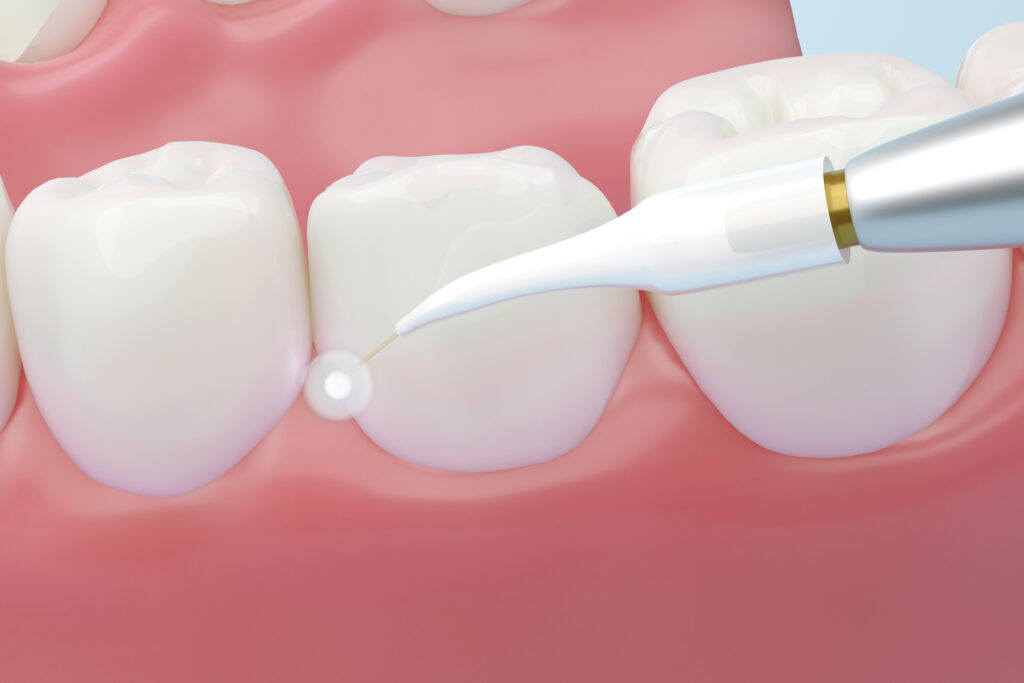 brooklyn perio dental lasers