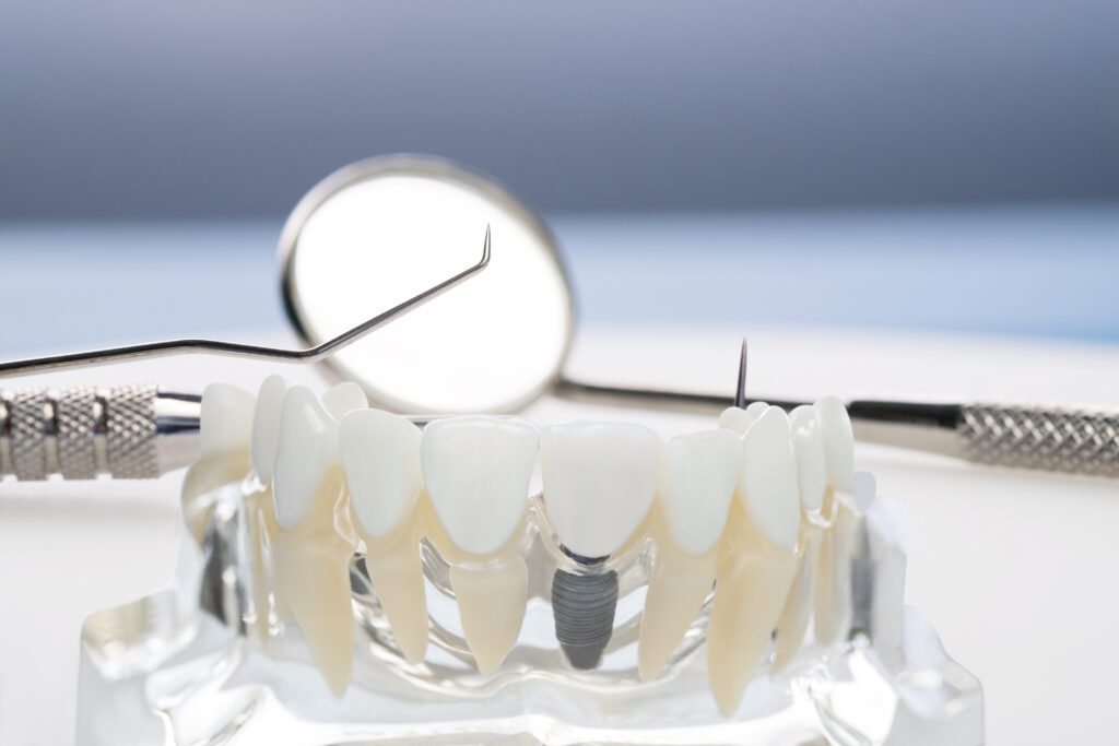 brooklyn dental implants