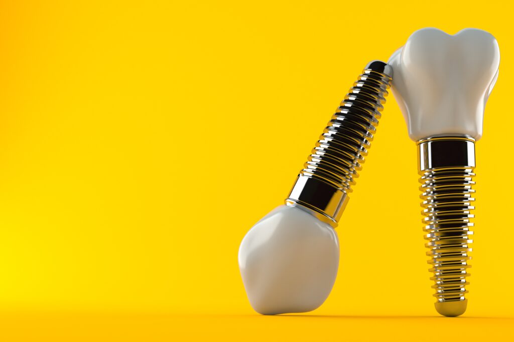 brooklyn dental implants