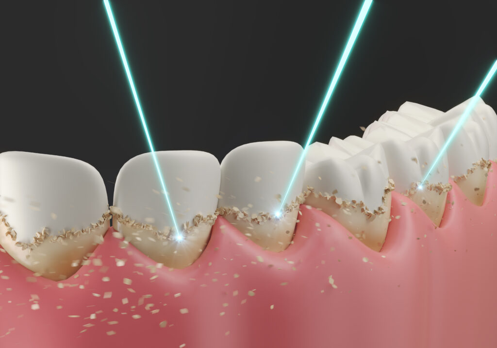 brooklyn periodontal lasers