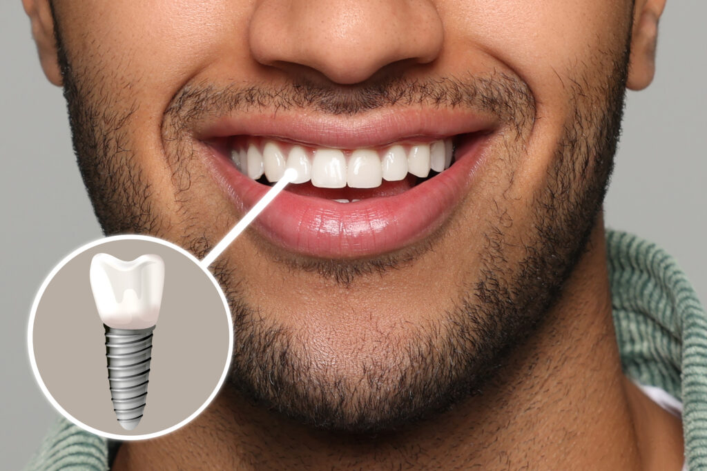 brooklyn dental implants