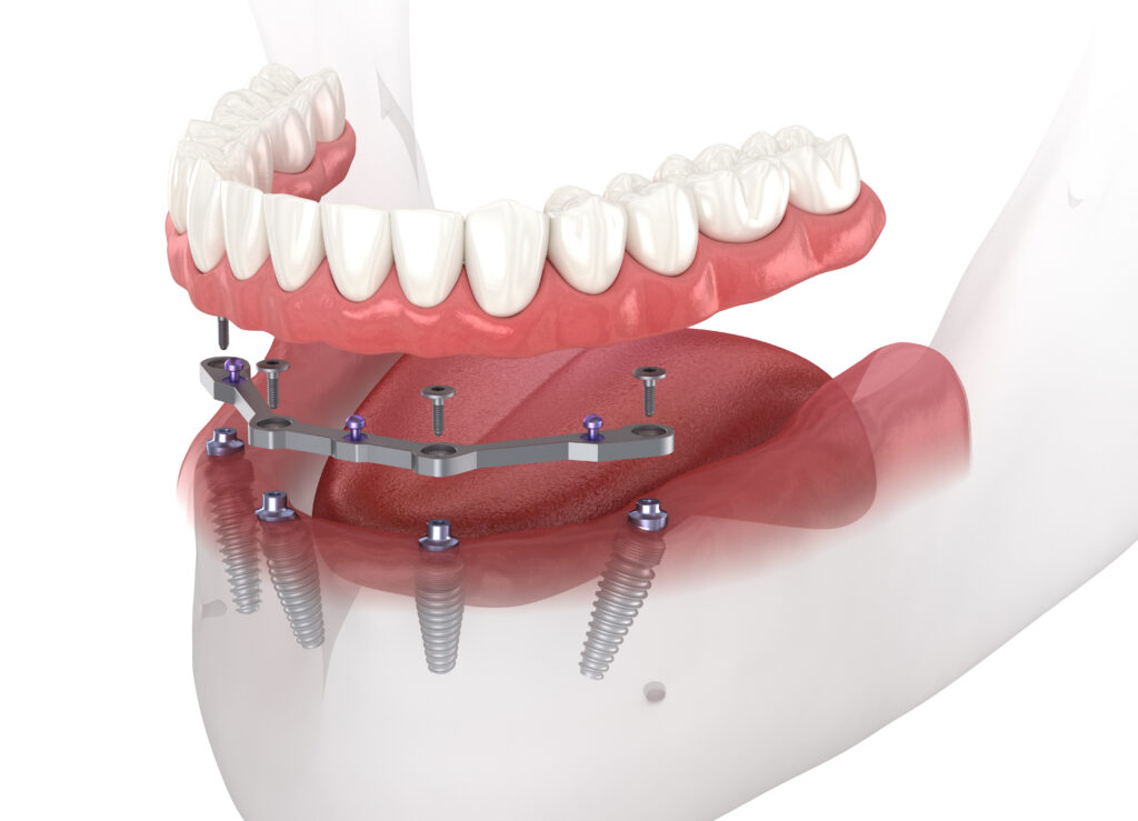 brooklyn implant dentures