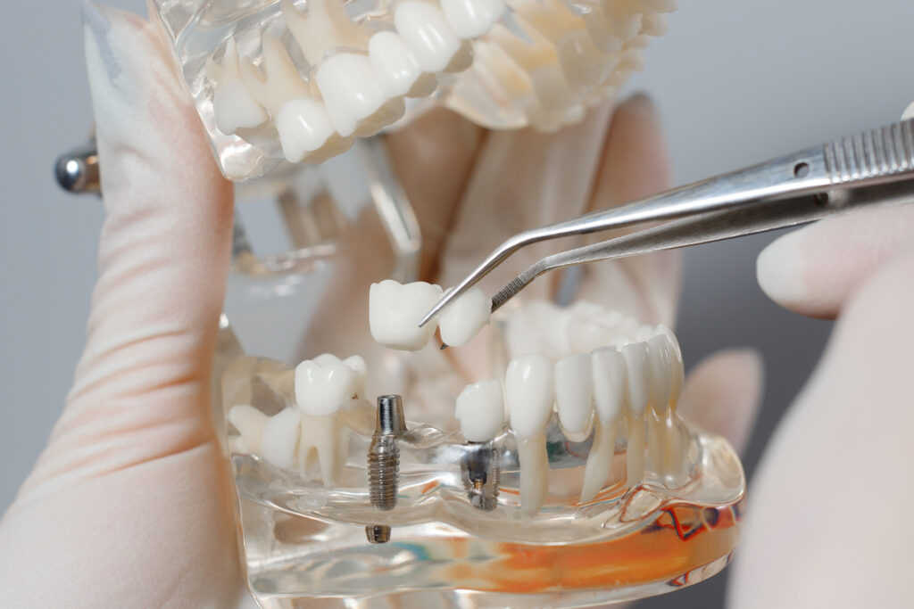 brooklyn dental implants