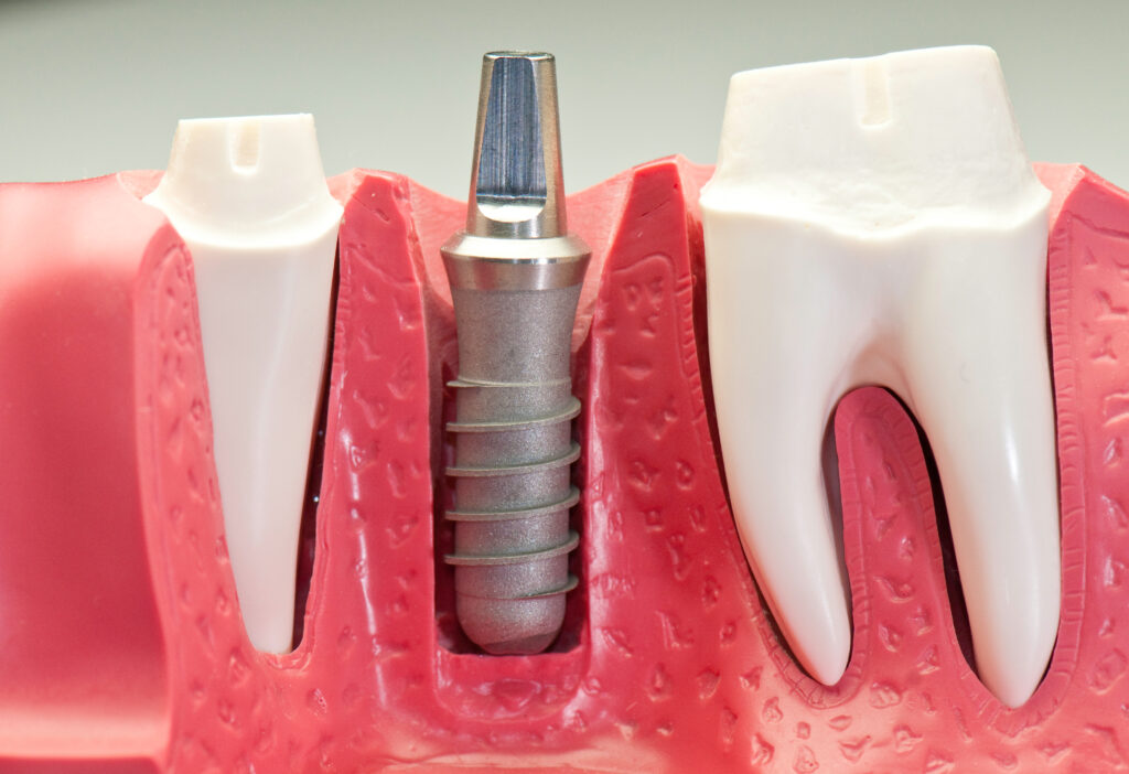 brooklyn same day dental implants