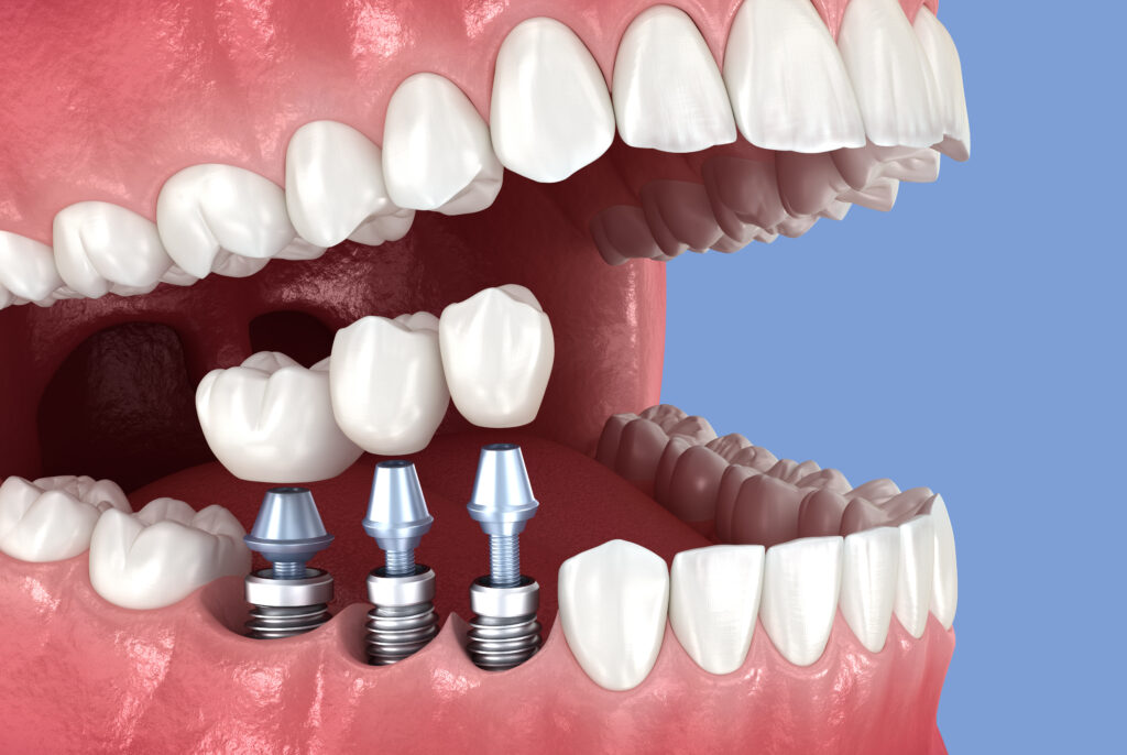 brooklyn perio dental implant