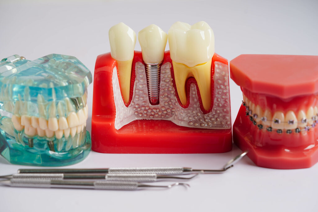 brooklyn perio dental implants