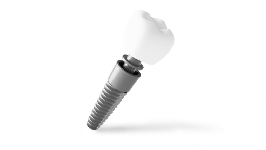 brooklyn perio in-house implant placement