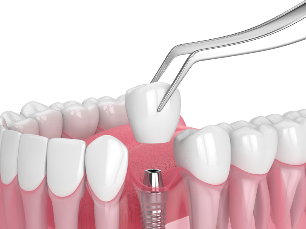 brooklyn perio implant technology