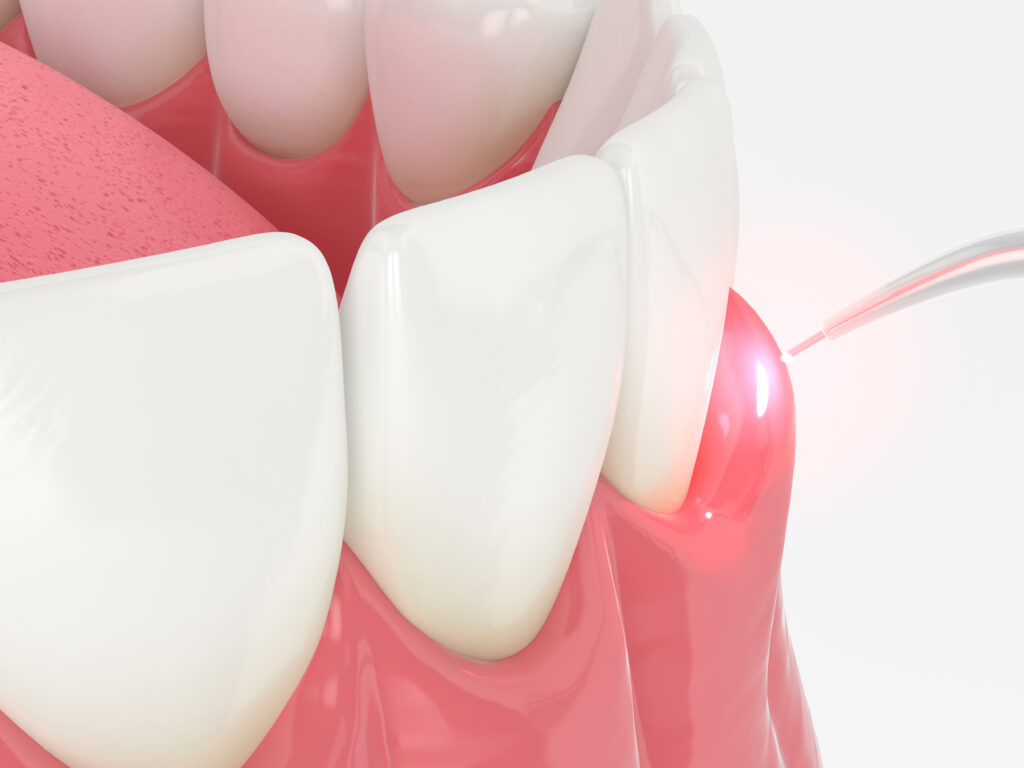 brooklyn perio laser treatment