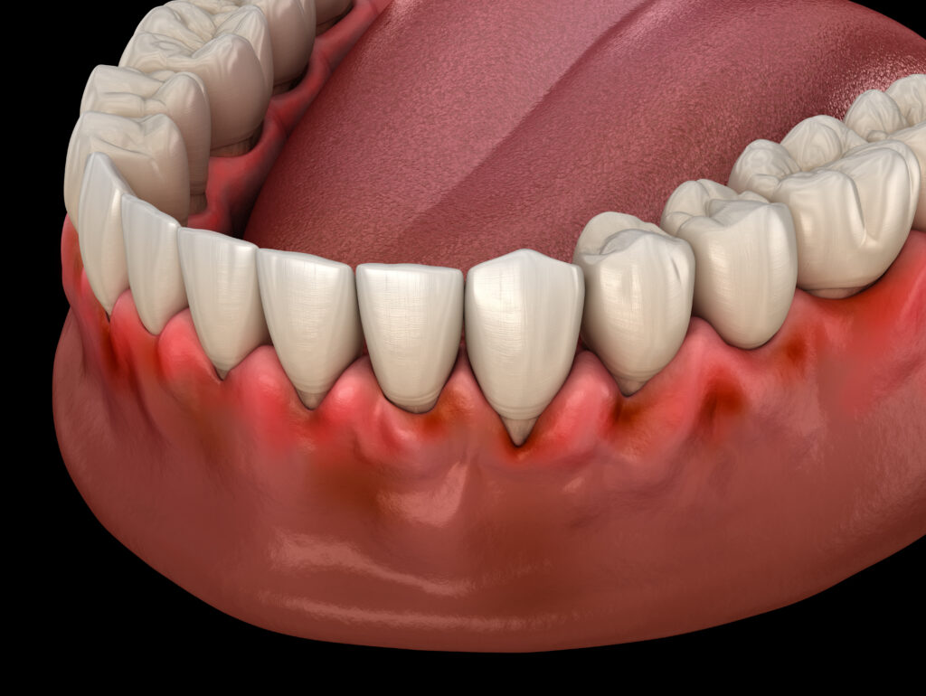 brooklyn perio gum disease