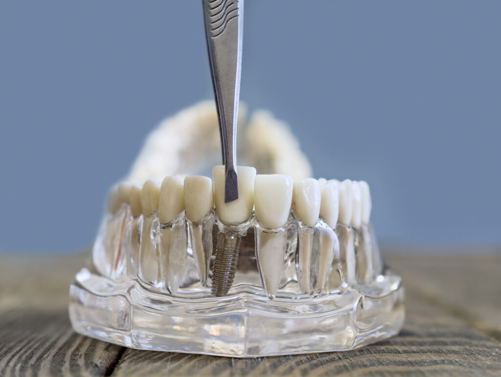 brooklyn perio dental implants