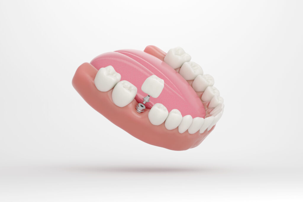 brooklyn perio dental implants