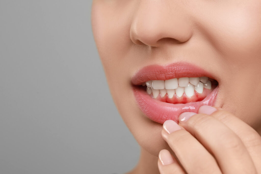 brooklyn gingivitis