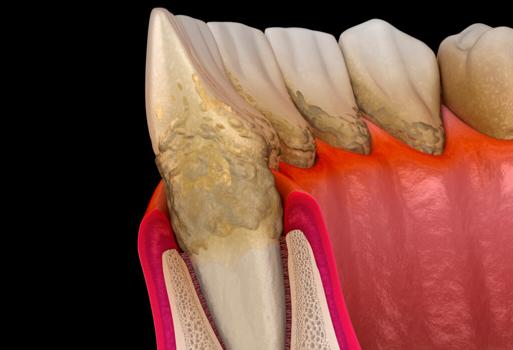 brooklyn periodontal disease