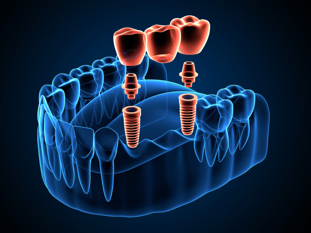 brooklyn perio dental implant tech