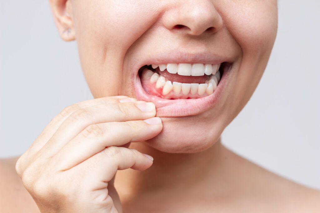 brooklyn gum disease