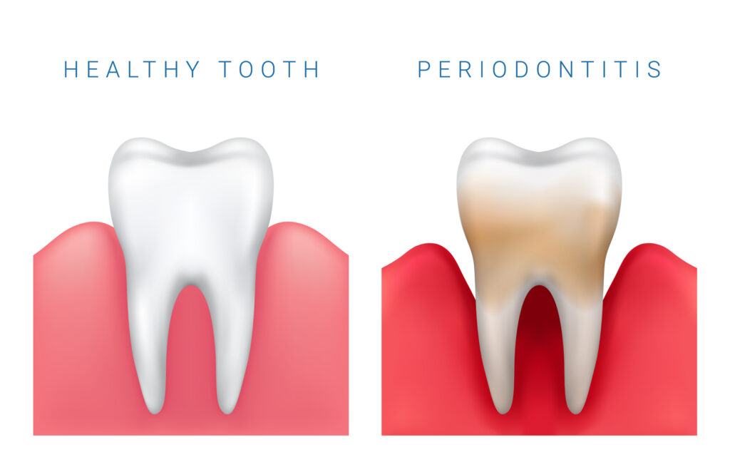 brooklyn perio periodontal treatment