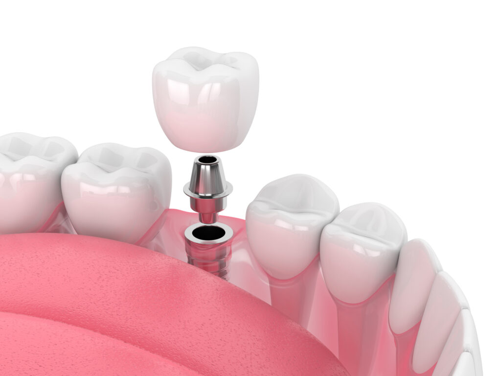 brooklyn perio dental implants