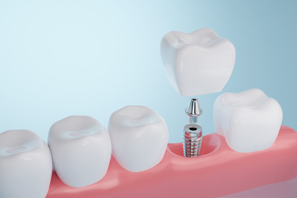 brooklyn perio dental implants
