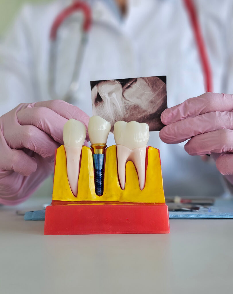 brooklyn perio dental implants