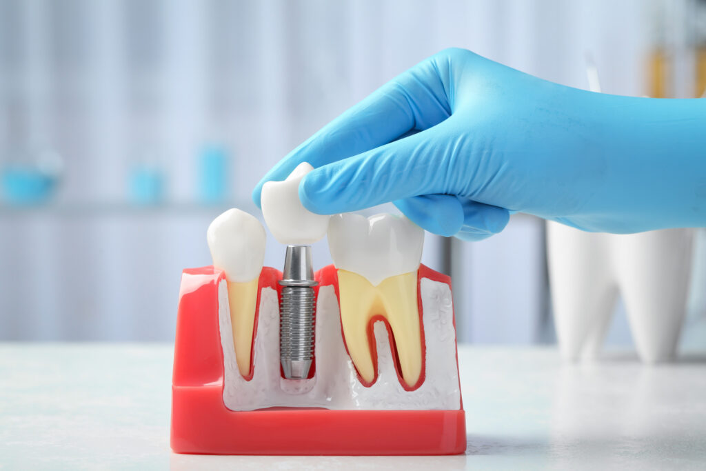 brooklyn dental implants