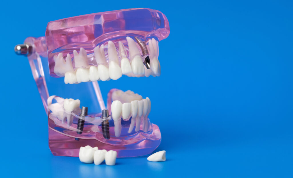 brooklyn perio dental implants