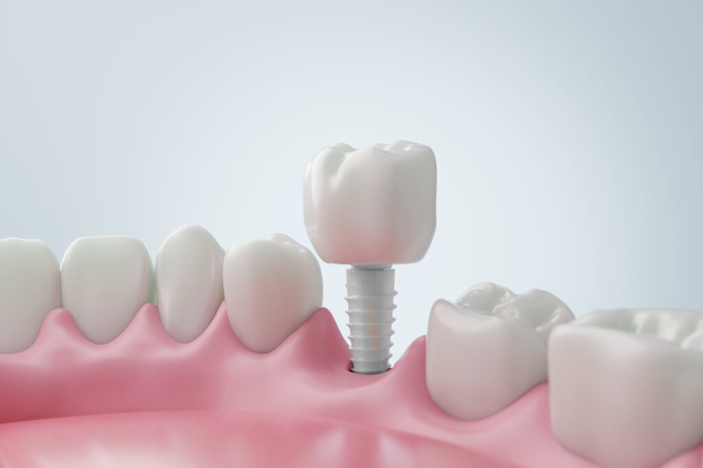 brooklyn perio dental implants