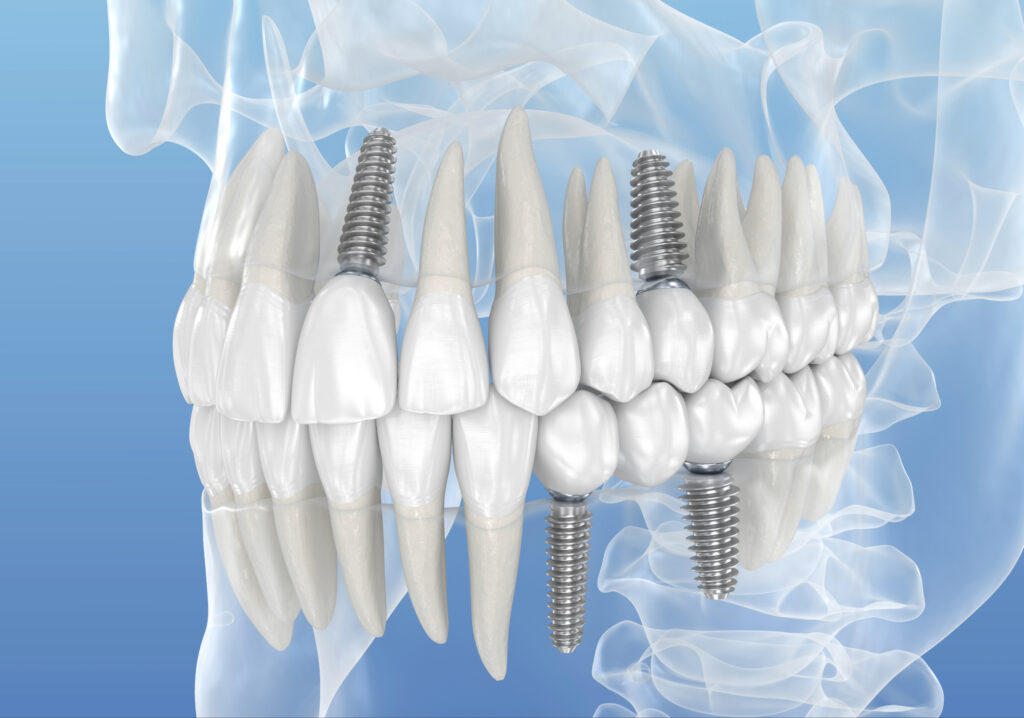 brooklyn dental implants