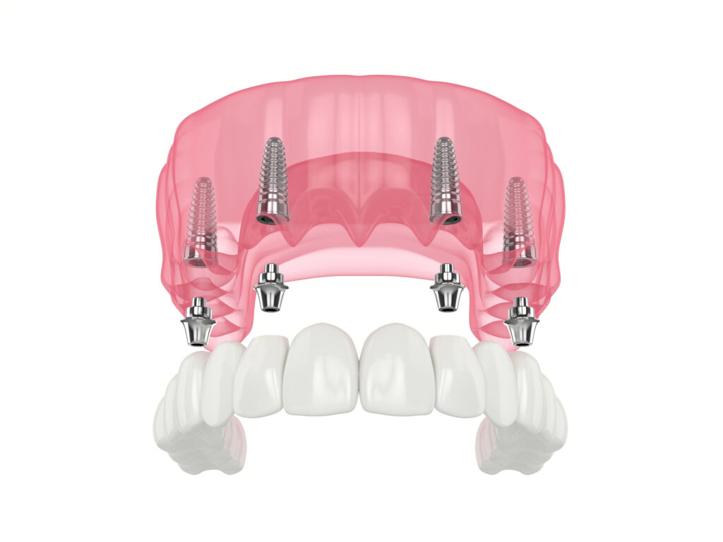 brooklyn perio dental implants
