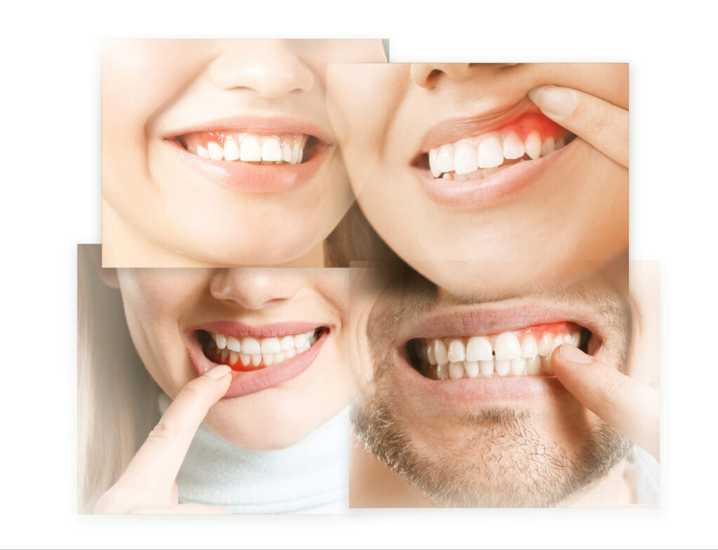 brooklyn perio gum disease