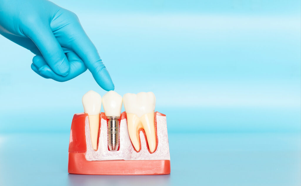 brooklyn perio tooth loss