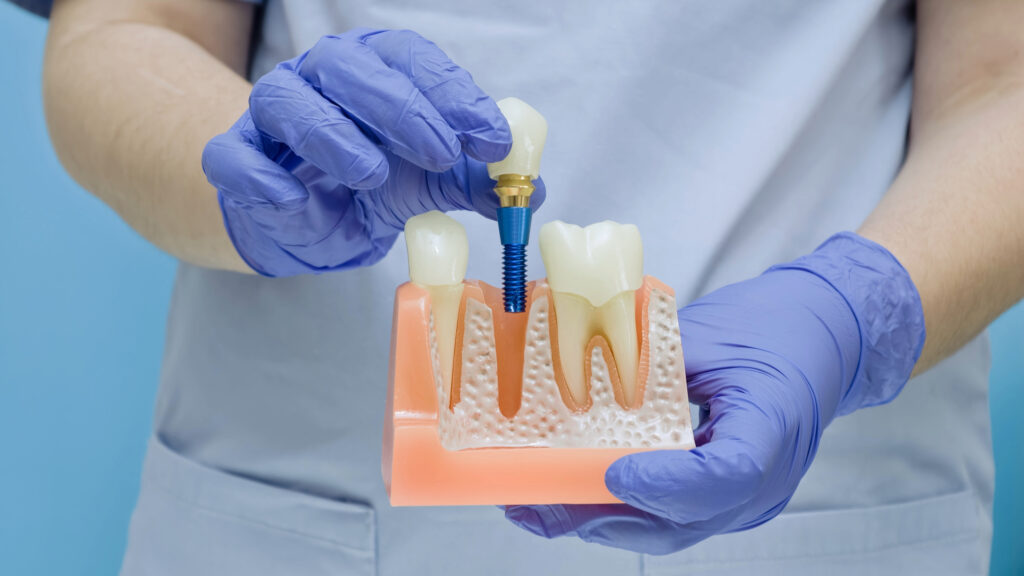 brooklyn perio dental implant crown
