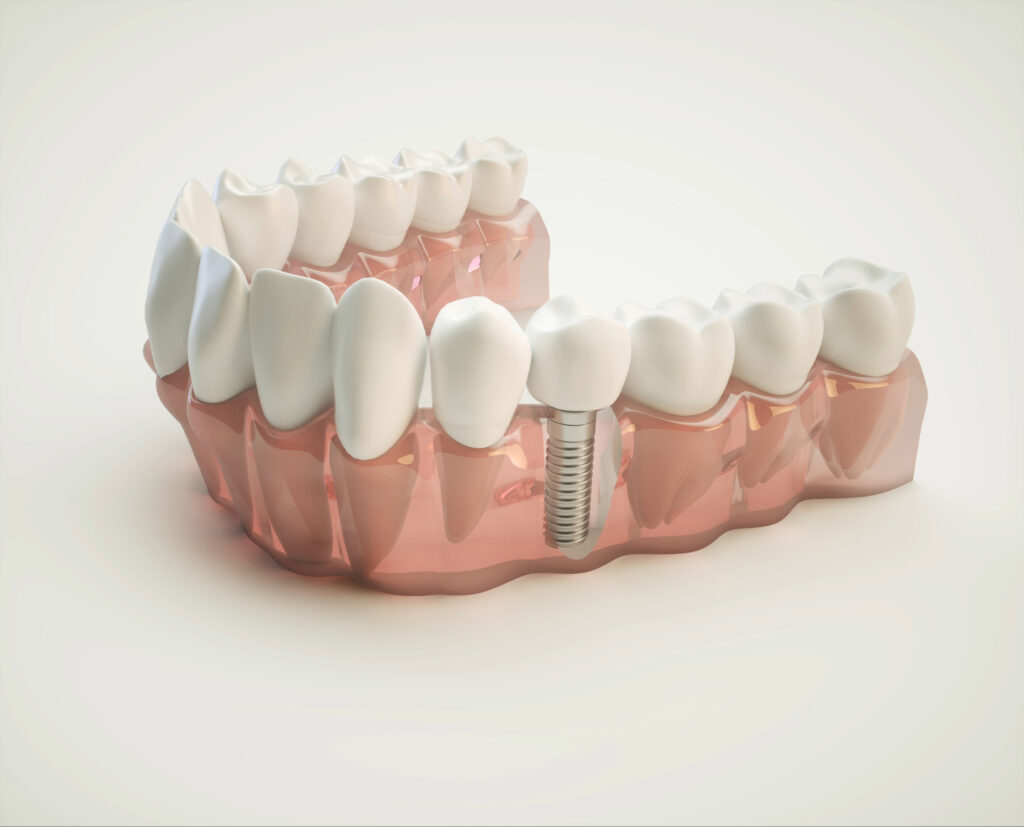 brooklyn perio dental implants