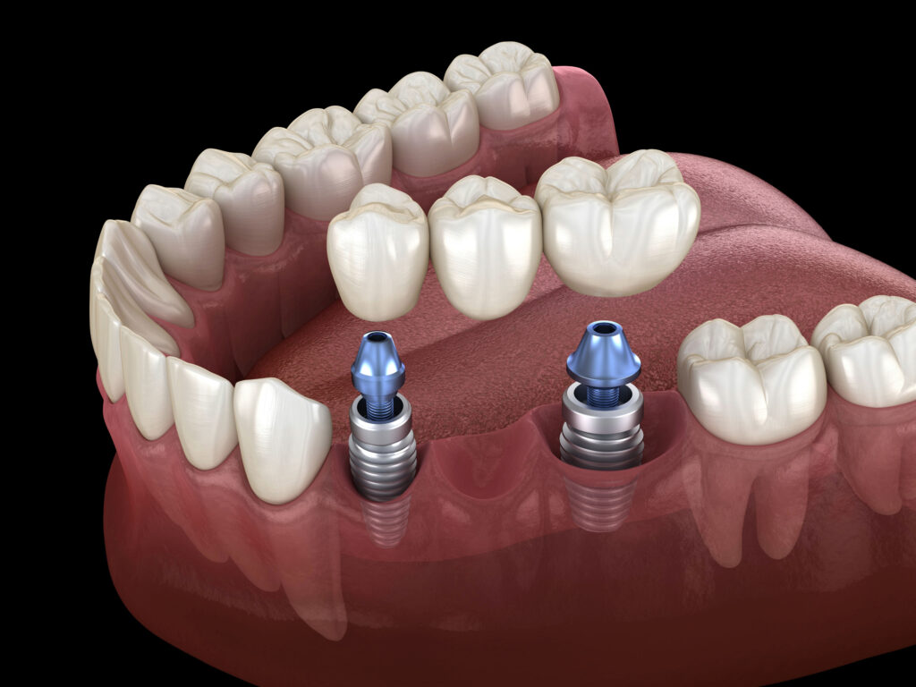 brooklyn perio implant bridges