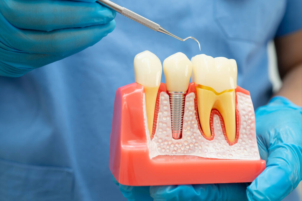 brooklyn perio dental implants