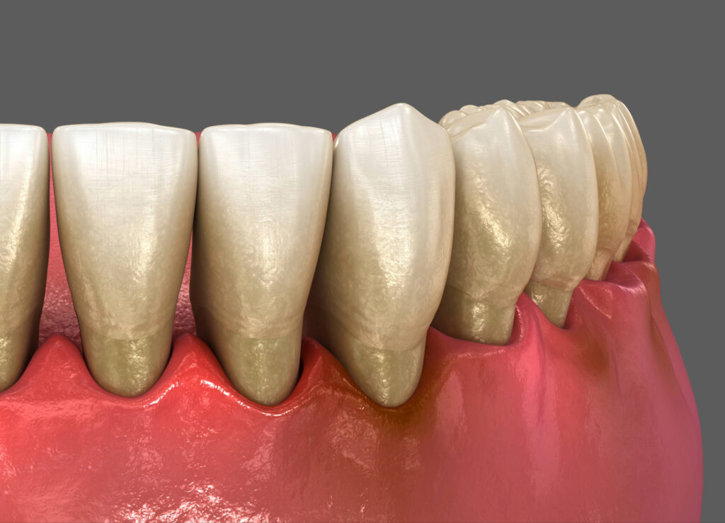 brooklyn perio gum disease